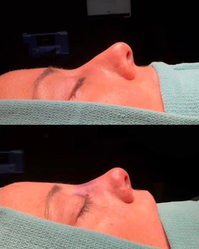 Functional Nasal Surgery Before & After Gallery - Patient 360273 - Image 1