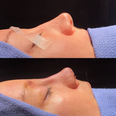 Revision Rhinoplasty Before & After Gallery - Patient 181228 - Image 1