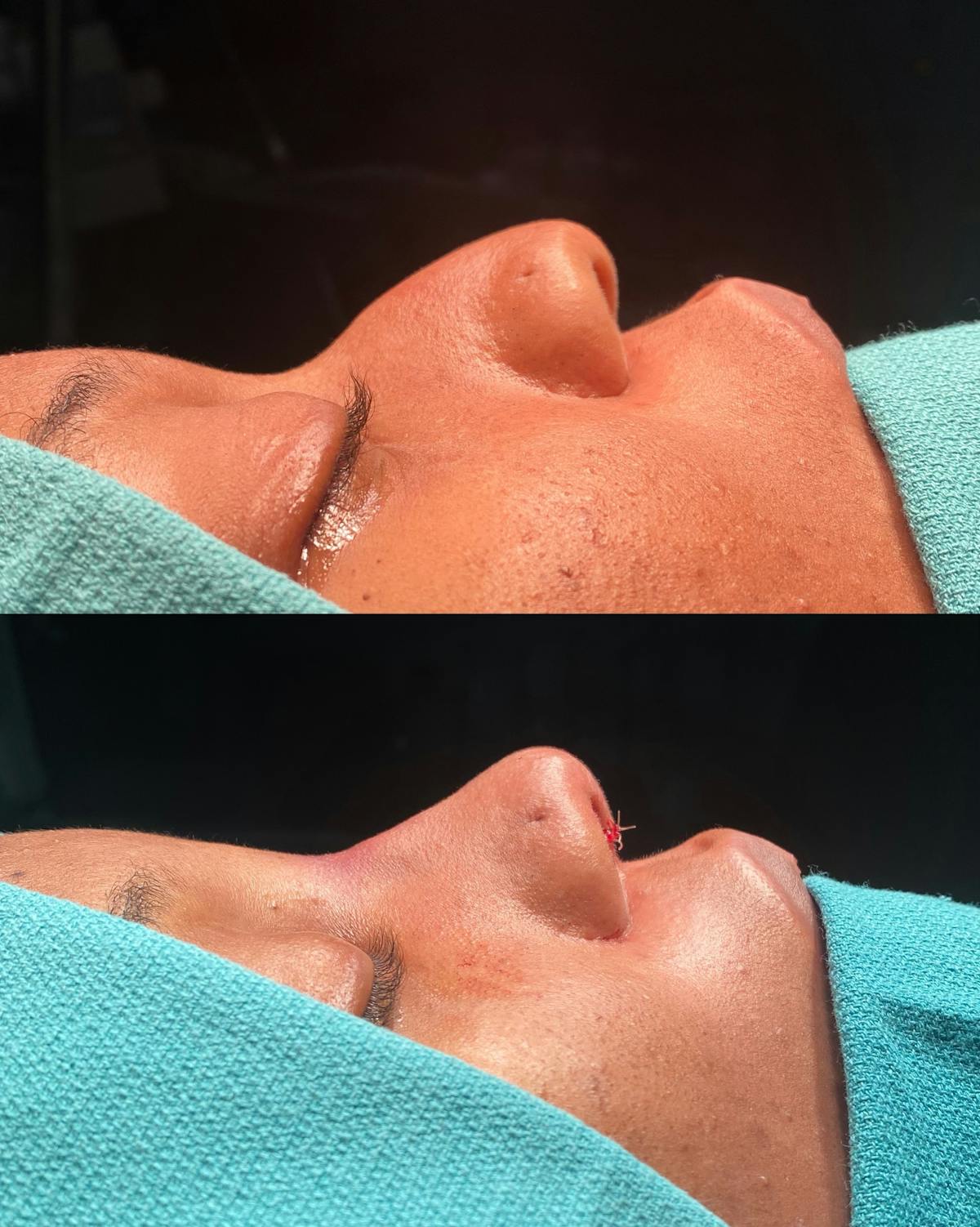 Functional Nasal Surgery Before & After Gallery - Patient 143898 - Image 1