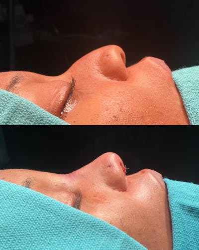 Functional Nasal Surgery Before & After Gallery - Patient 143898 - Image 1