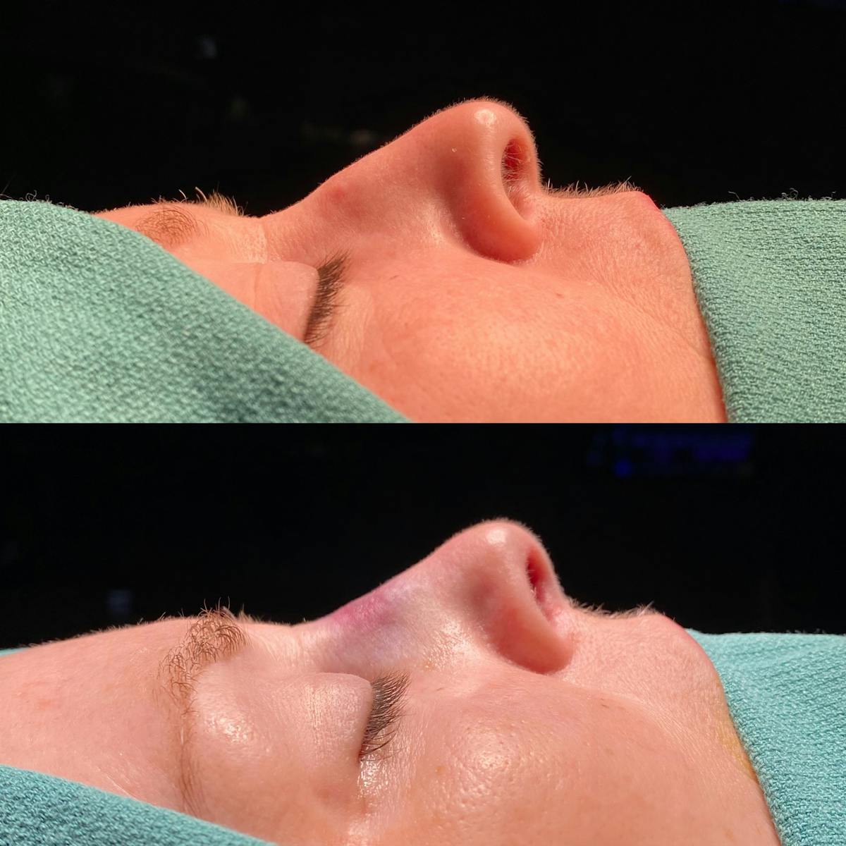 Rhinoplasty Before & After Gallery - Patient 390698 - Image 1