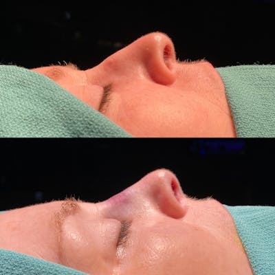 Functional Nasal Surgery Before & After Gallery - Patient 323838 - Image 1