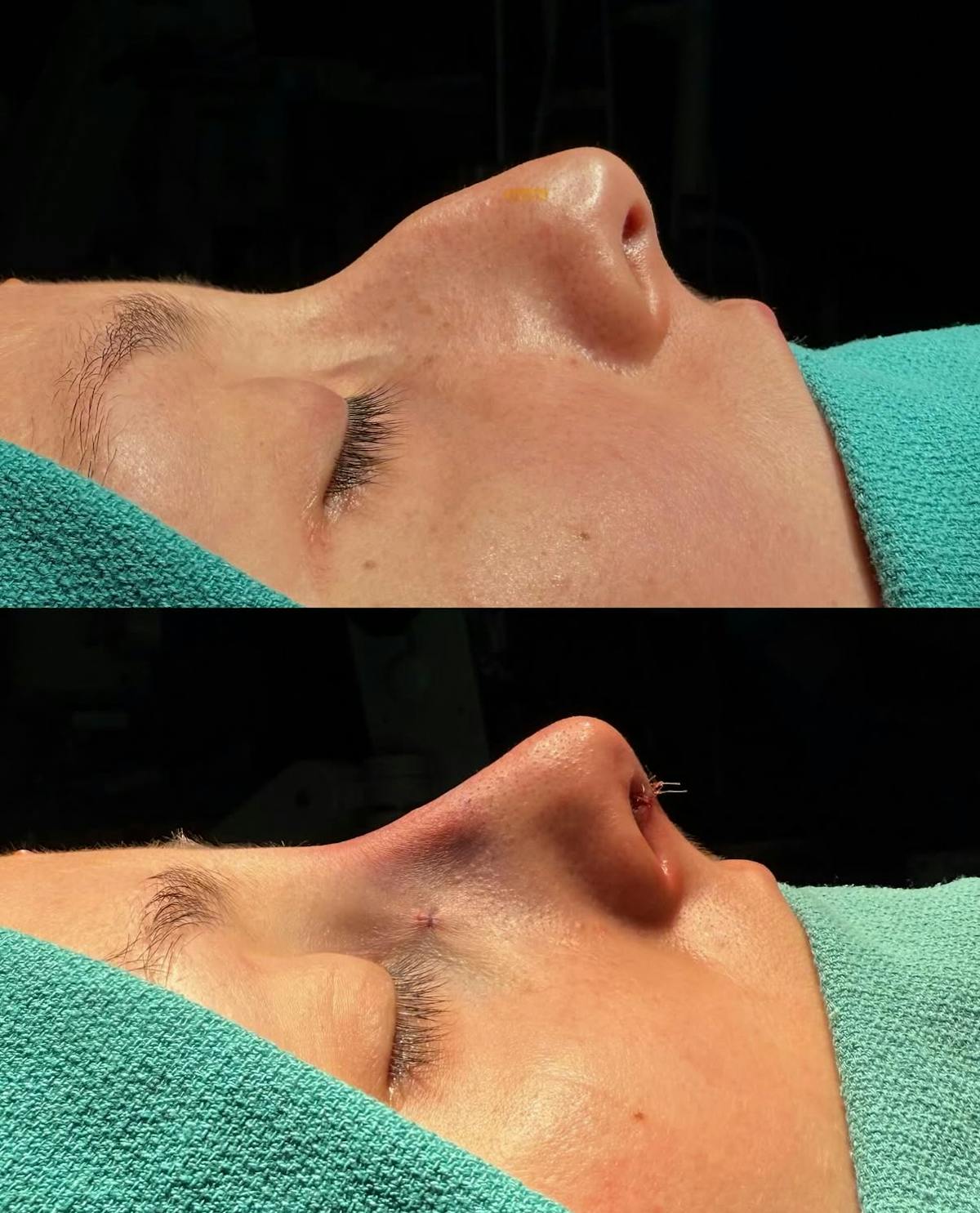 Rhinoplasty Before & After Gallery - Patient 271833 - Image 1