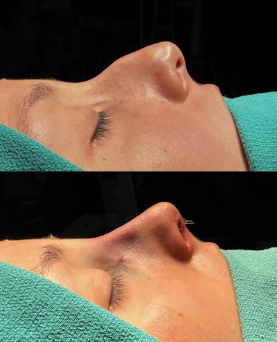 Rhinoplasty Before & After Gallery - Patient 271833 - Image 1