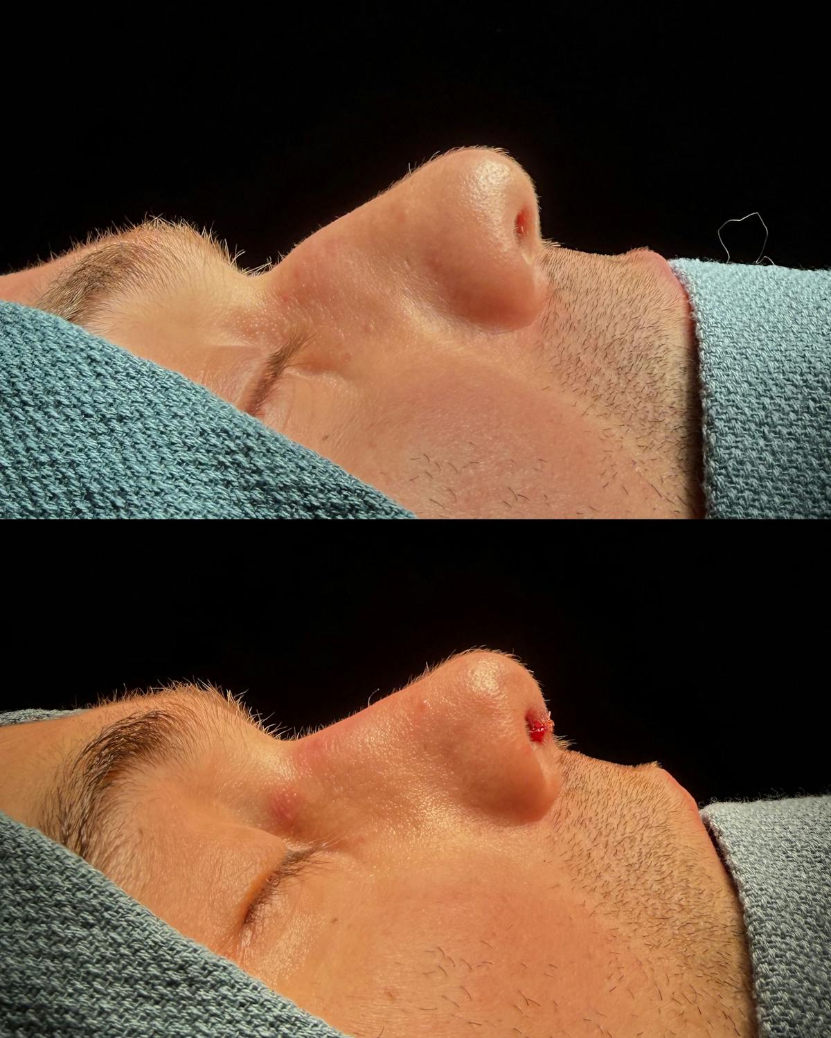 Rhinoplasty Before & After Gallery - Patient 126730 - Image 1