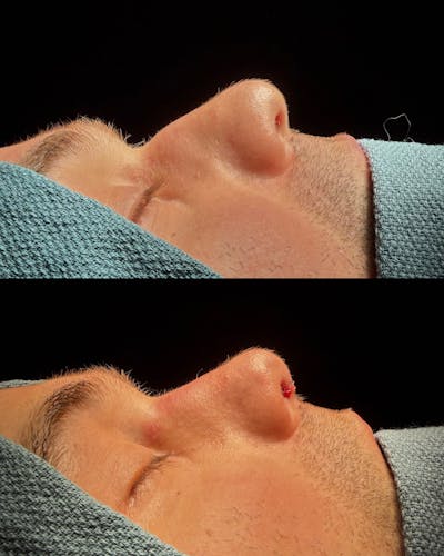 Functional Nasal Surgery Before & After Gallery - Patient 370816 - Image 1