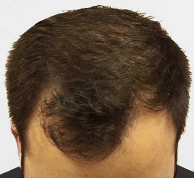 Hair Restoration