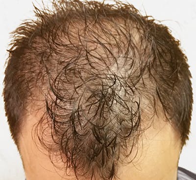 Hair Restoration