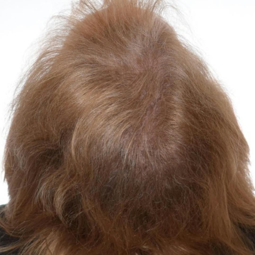 Hair Restoration