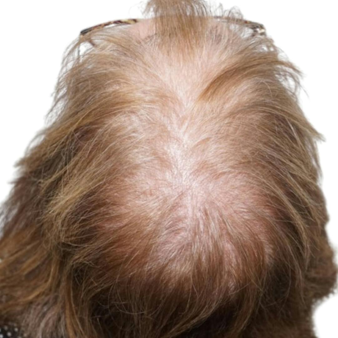 Hair Restoration
