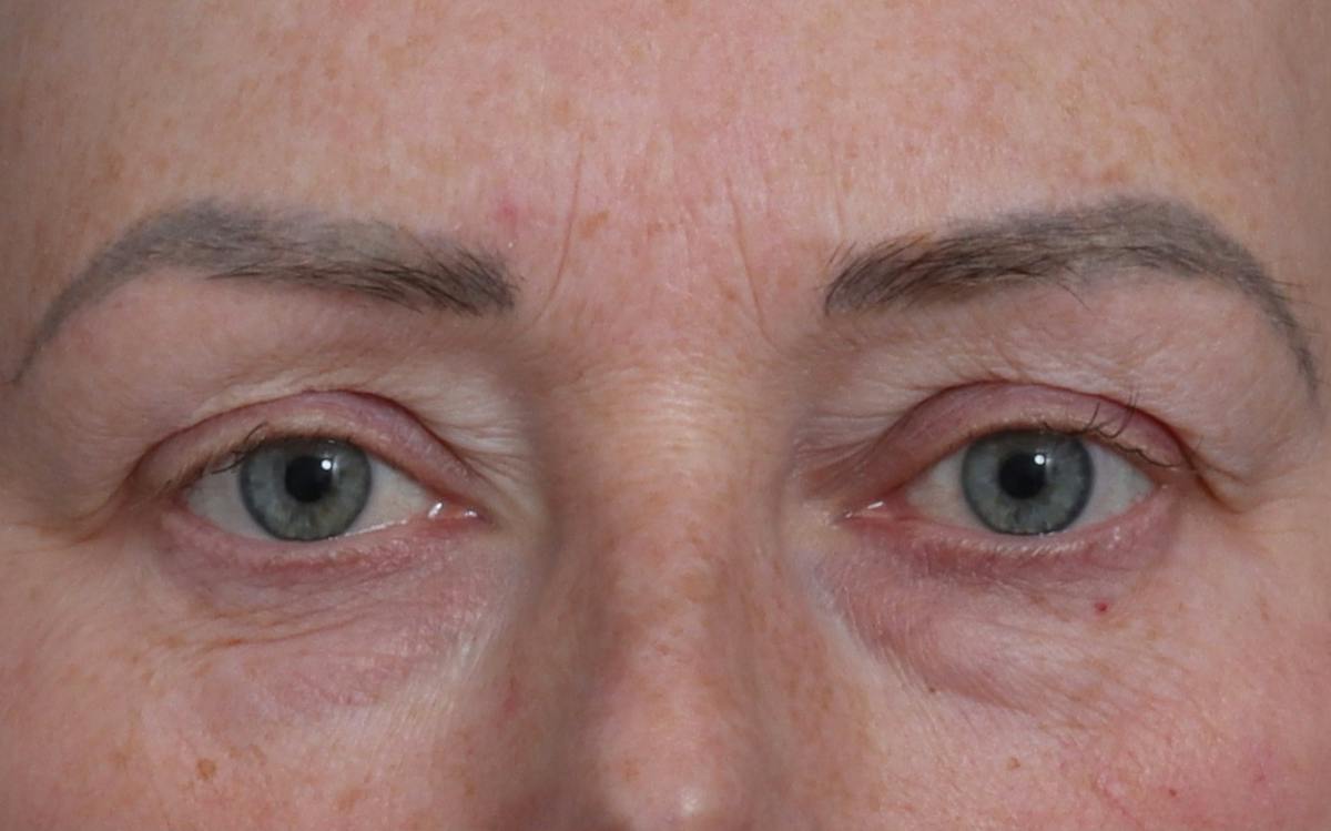 Blepharoplasty Before & After Gallery - Patient 205505 - Image 1