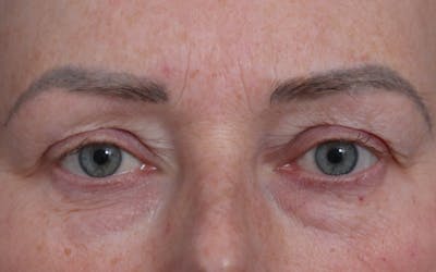 Blepharoplasty Before & After Gallery - Patient 205505 - Image 1