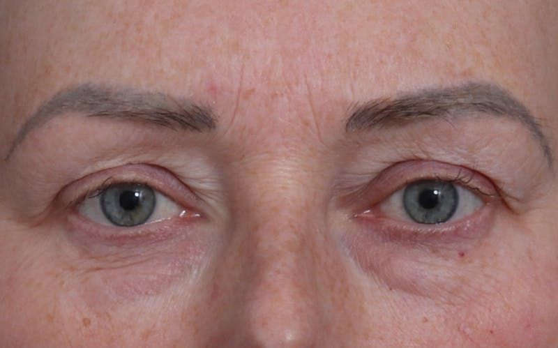 Blepharoplasty Before & After Gallery - Patient 205505 - Image 1