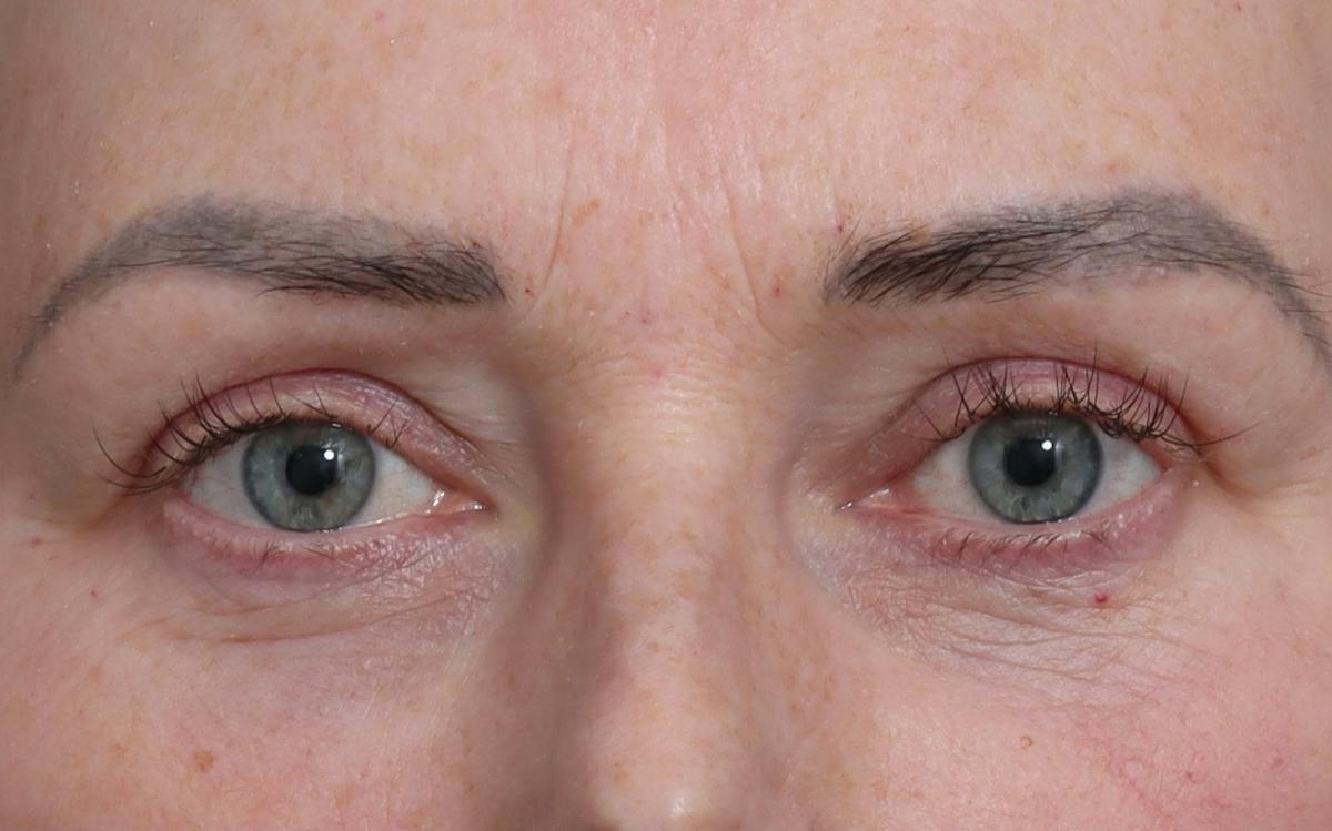 Blepharoplasty Before & After Gallery - Patient 205505 - Image 2