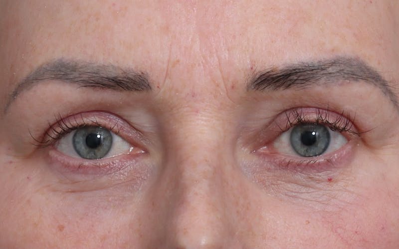 Blepharoplasty Before & After Gallery - Patient 205505 - Image 2