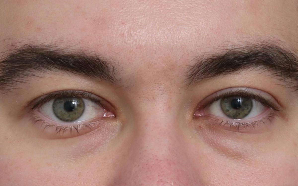 Blepharoplasty Before & After Gallery - Patient 210839 - Image 1