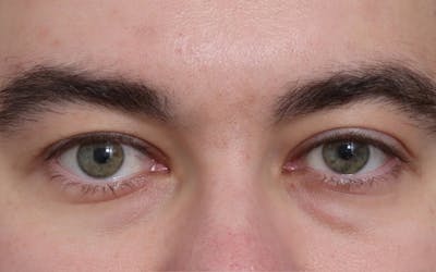 Blepharoplasty Before & After Gallery - Patient 210839 - Image 1
