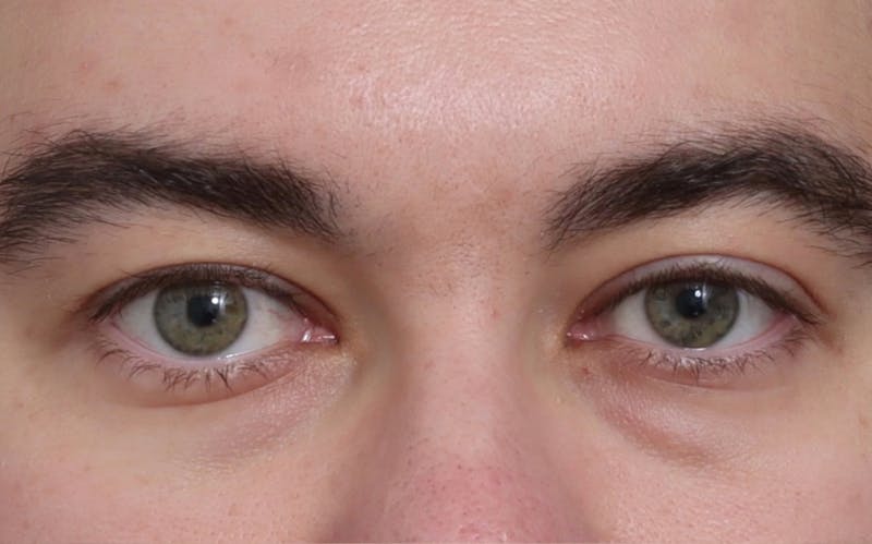 Blepharoplasty Before & After Gallery - Patient 210839 - Image 1