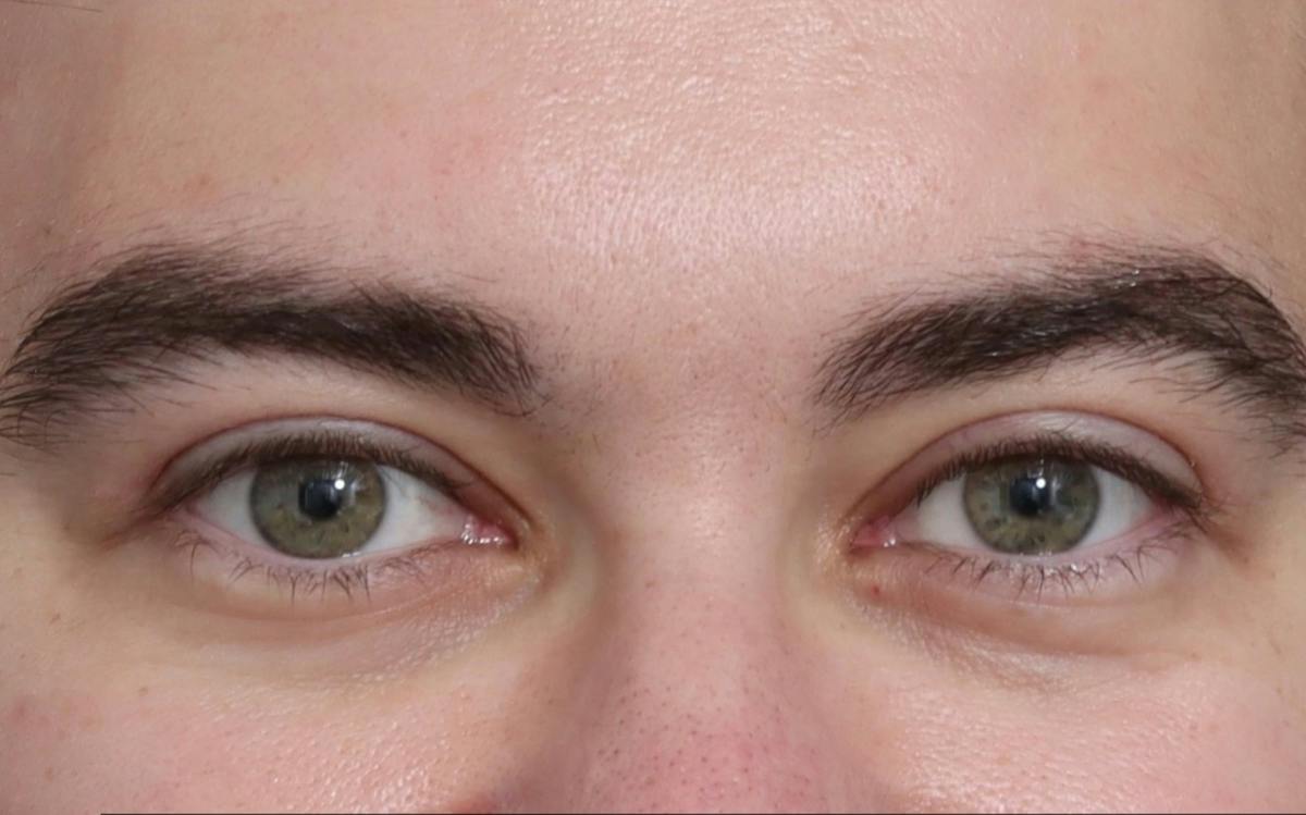 Blepharoplasty Before & After Gallery - Patient 210839 - Image 2