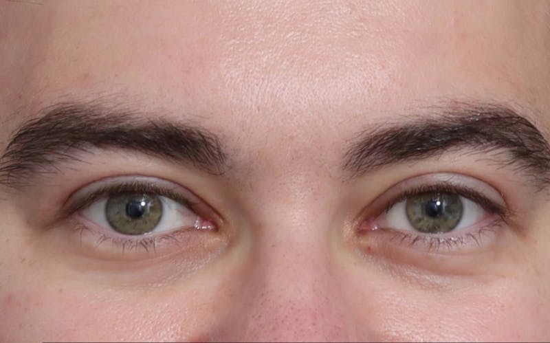Blepharoplasty Before & After Gallery - Patient 210839 - Image 2
