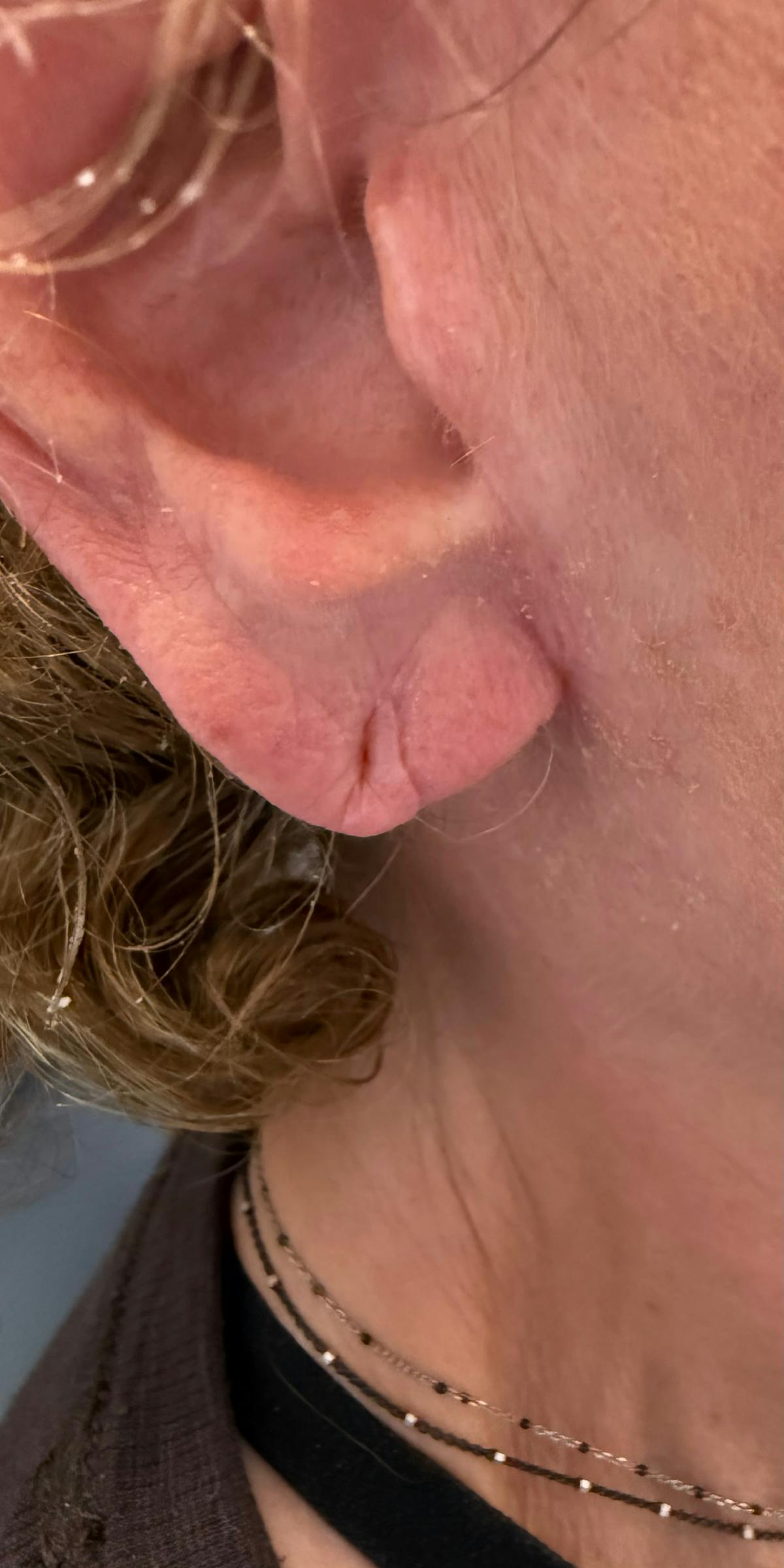 Dermal Filler Before & After Gallery - Patient 225710 - Image 1
