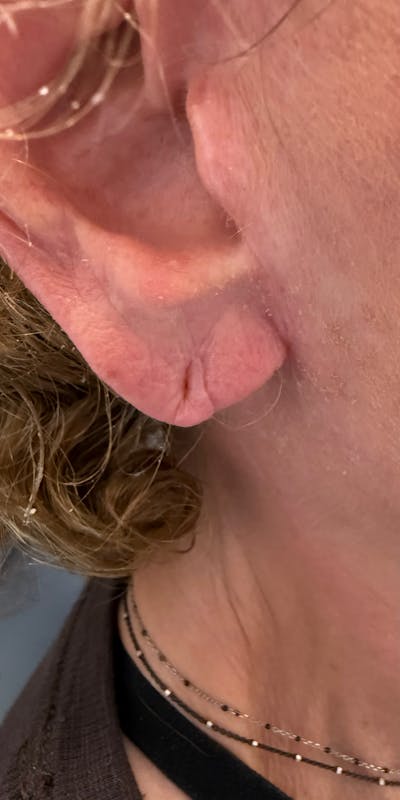 Dermal Filler Before & After Gallery - Patient 225710 - Image 1
