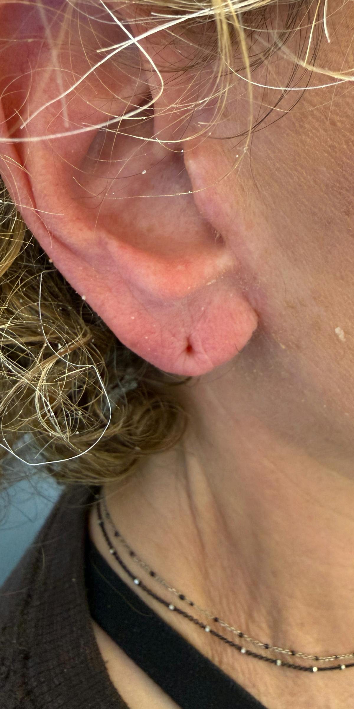 Dermal Filler Before & After Gallery - Patient 225710 - Image 2