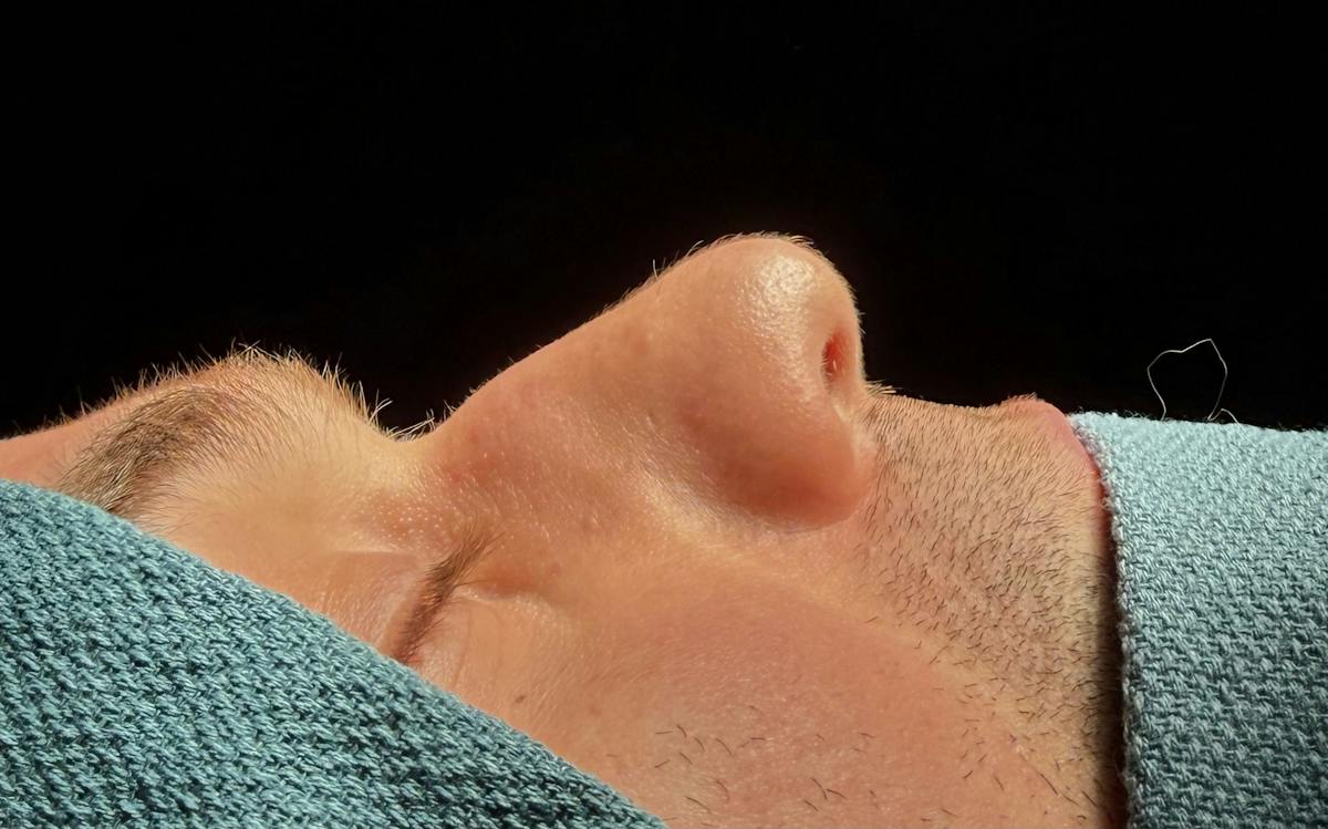Rhinoplasty Before & After Gallery - Patient 126730 - Image 1