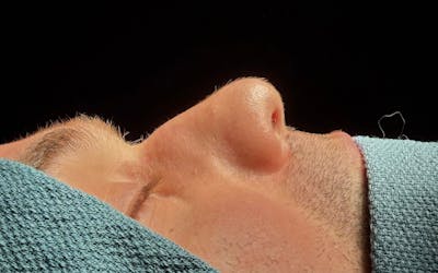 Functional Nasal Surgery Before & After Gallery - Patient 370816 - Image 1