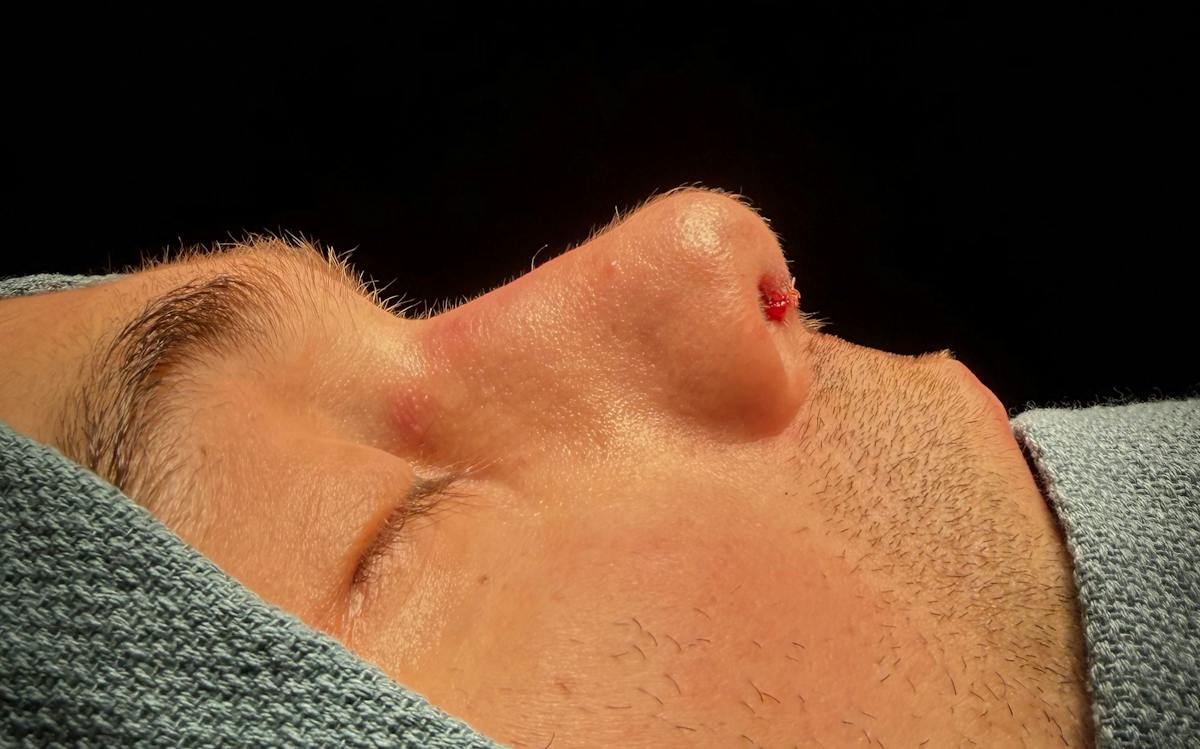 Rhinoplasty Before & After Gallery - Patient 126730 - Image 2