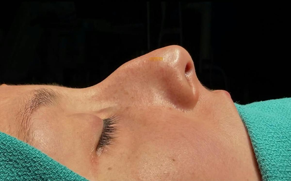 Rhinoplasty Before & After Gallery - Patient 271833 - Image 1