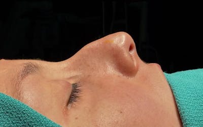 Rhinoplasty Before & After Gallery - Patient 271833 - Image 1