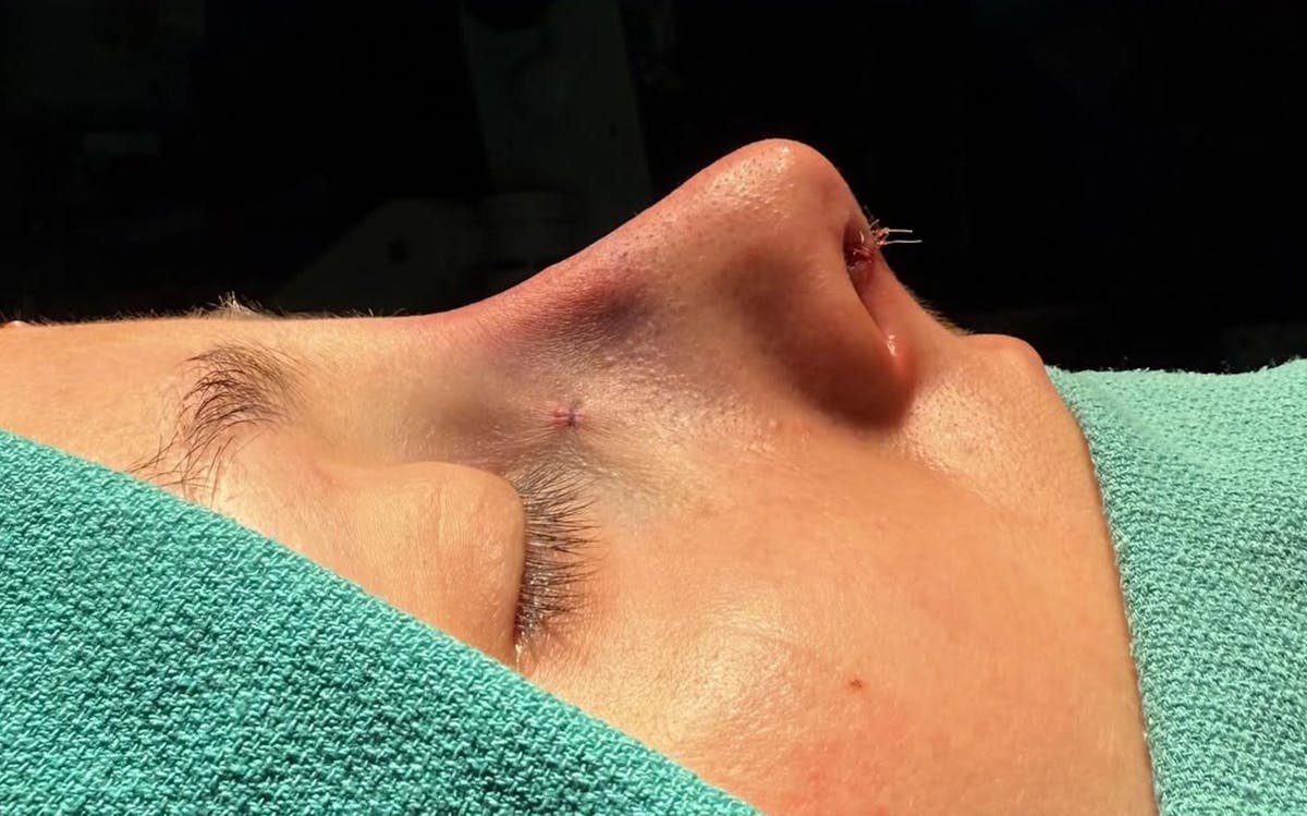 Rhinoplasty Before & After Gallery - Patient 271833 - Image 2
