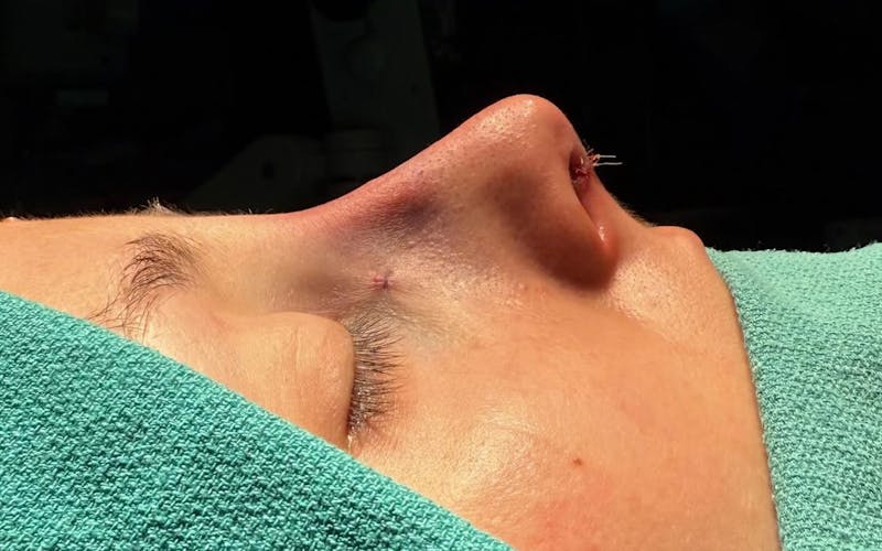 Rhinoplasty Before & After Gallery - Patient 271833 - Image 2