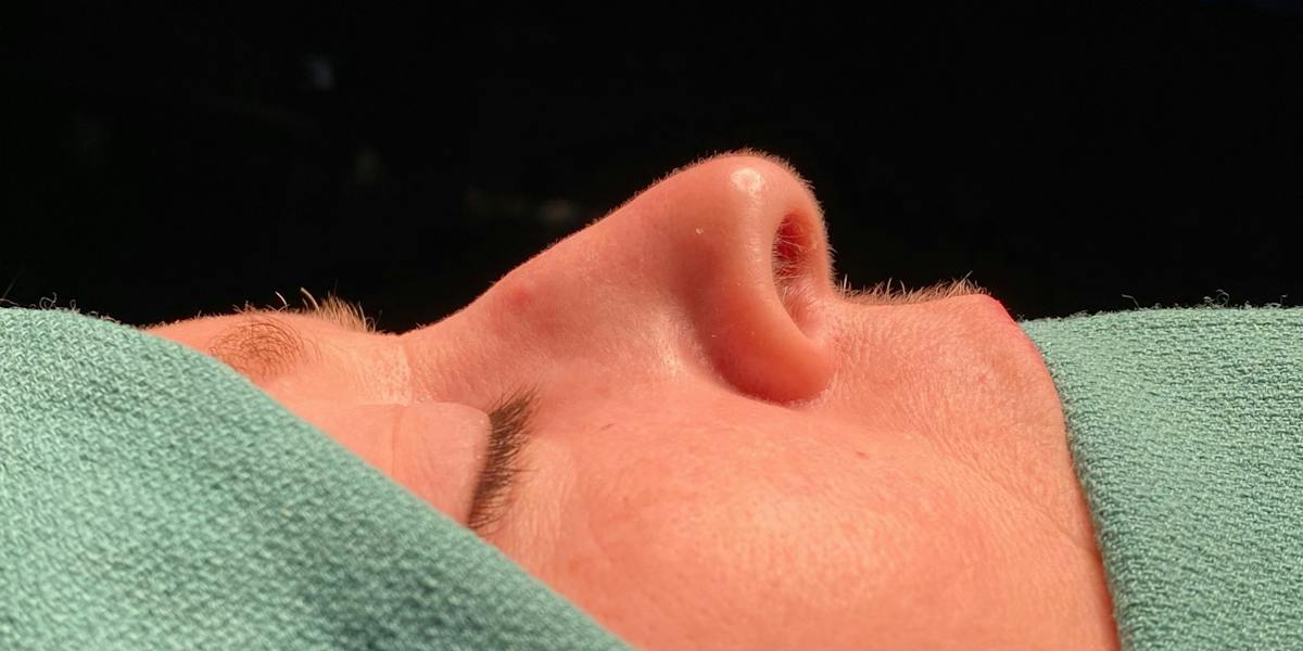 Functional Nasal Surgery Before & After Gallery - Patient 323838 - Image 1