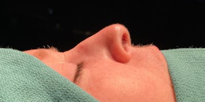 Functional Nasal Surgery Before & After Gallery - Patient 323838 - Image 1