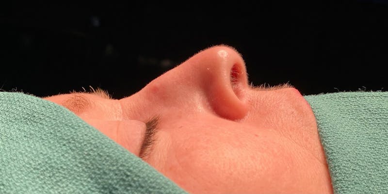 Rhinoplasty Before & After Gallery - Patient 390698 - Image 1