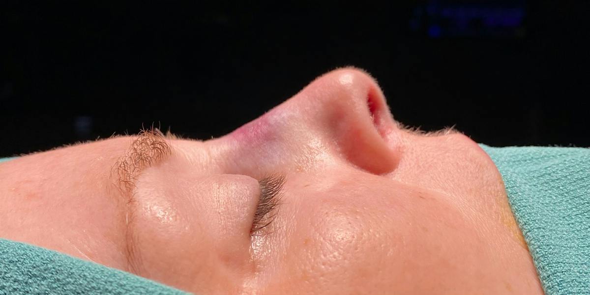 Functional Nasal Surgery Before & After Gallery - Patient 323838 - Image 2