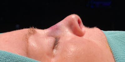 Functional Nasal Surgery Before & After Gallery - Patient 323838 - Image 2