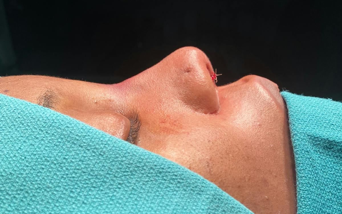 Rhinoplasty Before & After Gallery - Patient 110182 - Image 2