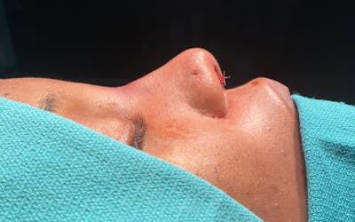 Functional Nasal Surgery Before & After Gallery - Patient 143898 - Image 2