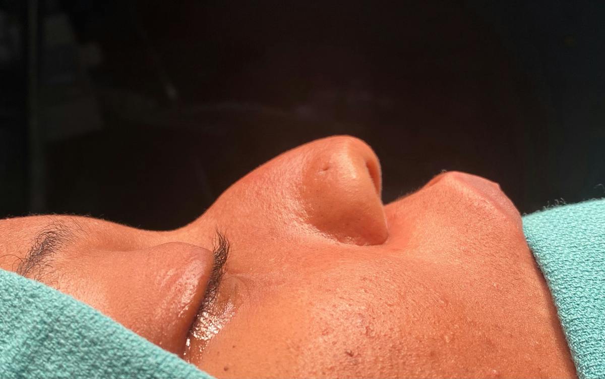 Rhinoplasty Before & After Gallery - Patient 110182 - Image 1