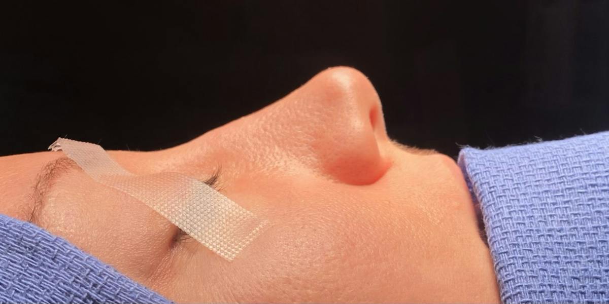 Rhinoplasty Before & After Gallery - Patient 309026 - Image 1