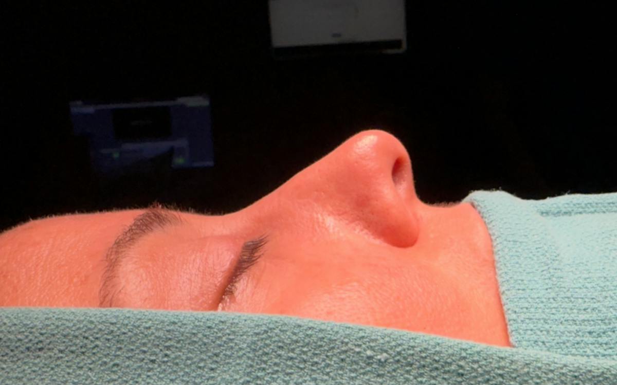 Functional Nasal Surgery Before & After Gallery - Patient 360273 - Image 1