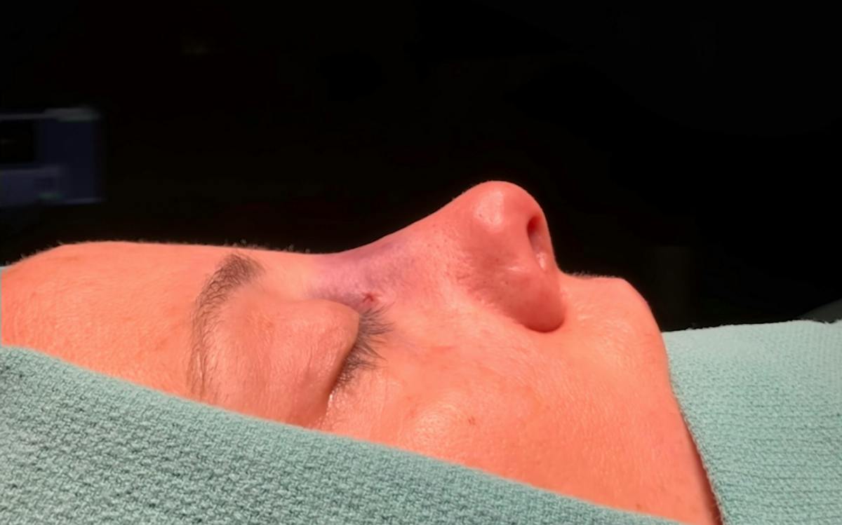 Functional Nasal Surgery Before & After Gallery - Patient 360273 - Image 2