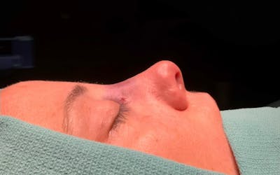 Functional Nasal Surgery Before & After Gallery - Patient 360273 - Image 2