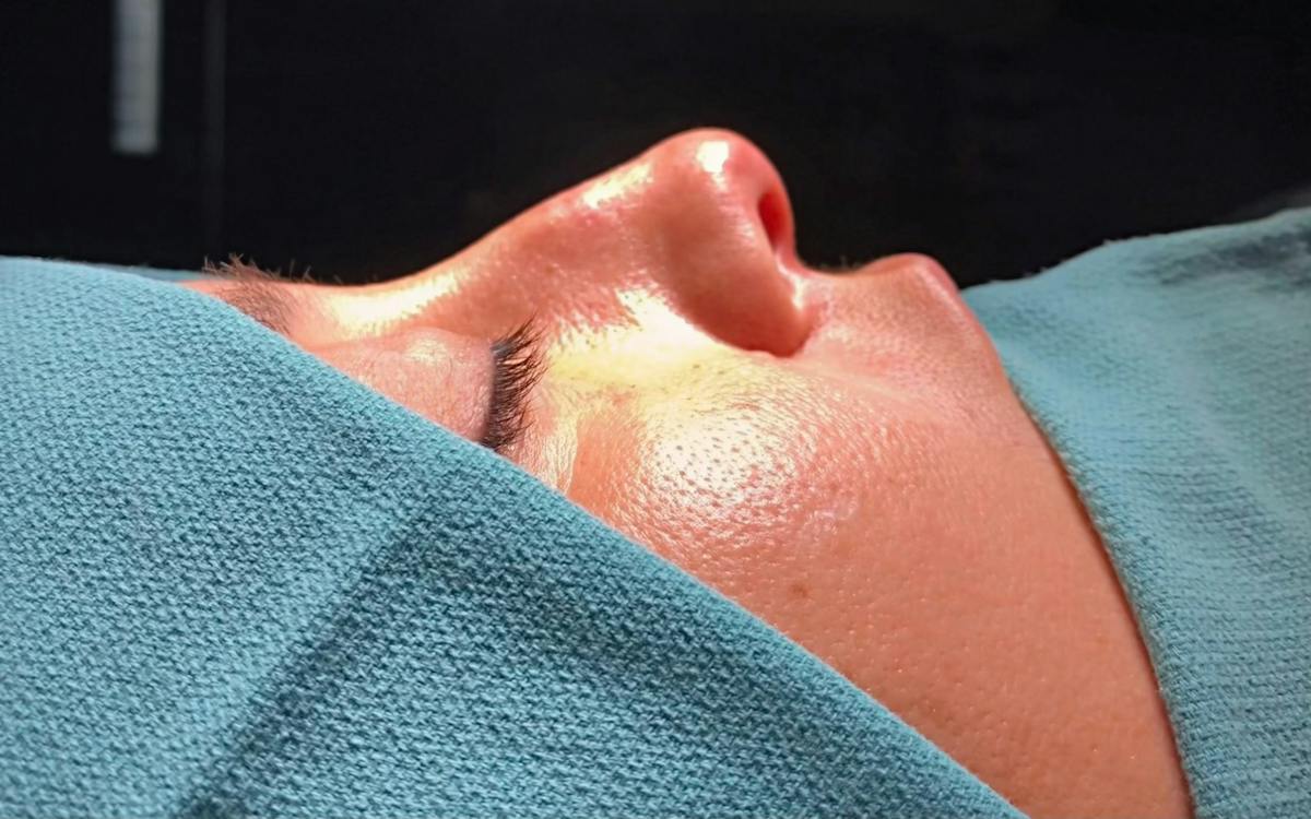 Functional Nasal Surgery Before & After Gallery - Patient 194670 - Image 1