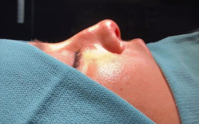 Functional Nasal Surgery Before & After Gallery - Patient 194670 - Image 1