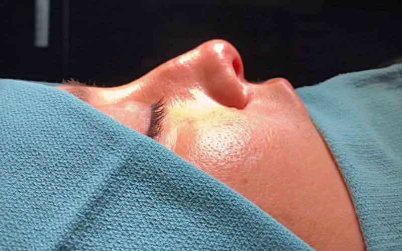 Functional Nasal Surgery Before & After Gallery - Patient 194670 - Image 1