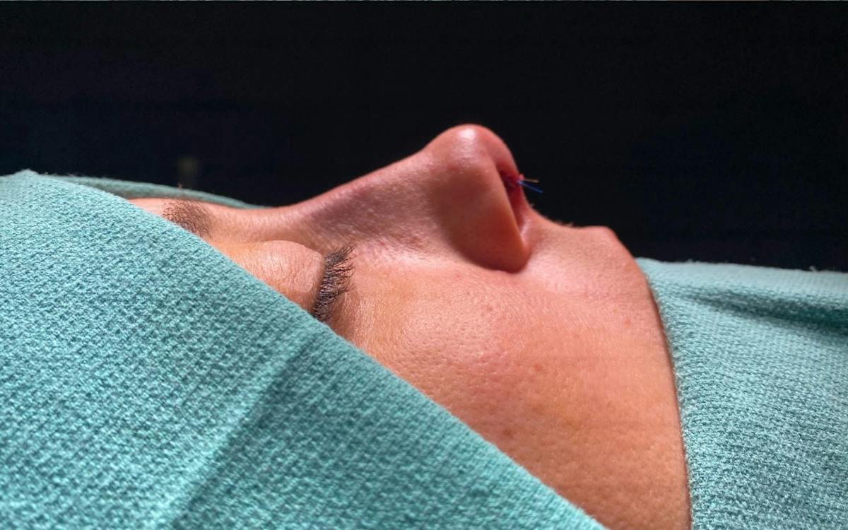 Functional Nasal Surgery Before & After Gallery - Patient 194670 - Image 2